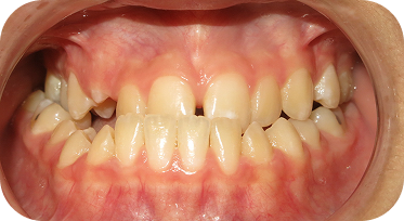 SeaTac Orthodontics Before Smile