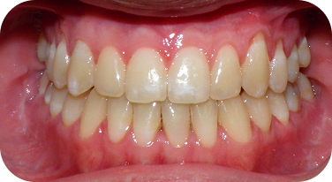 SeaTac Patient After Orthodontist