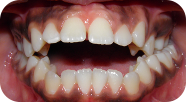 Renton Orthodontist Before Invisalign