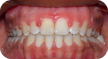 Renton Braces Patient Afterwards