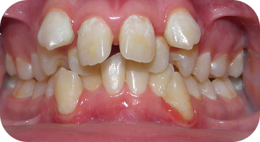 Burien Patient Orthodontics Before