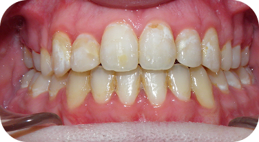 Burien Smile Post Invisalign