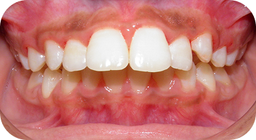 Northgate Orthodontics Patient Before