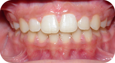Northgate Smile After Invisalign