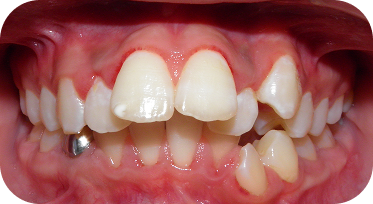 Bitter Lake Orthodontist Before