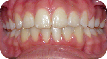 Bitter Lake Smile After Invisalign