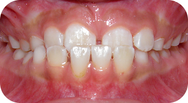 Bitter Lake Braces Patient