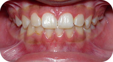 Lake City Patient After Braces