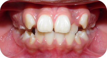 Lake City Orthodontics for Invisalign Patient