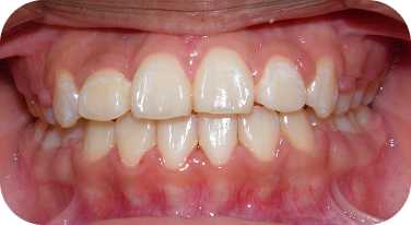 Northgate Patient Finishing Braces