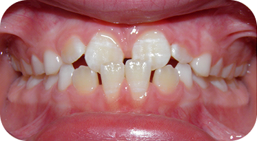 Shoreline Braces for Patient