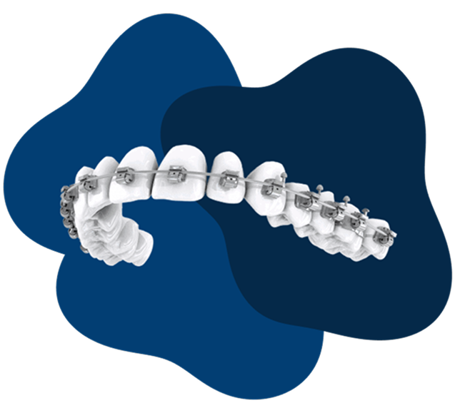 Braces in Tukwila, WA and Northgate, WA