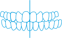 Invisalign Crossbite